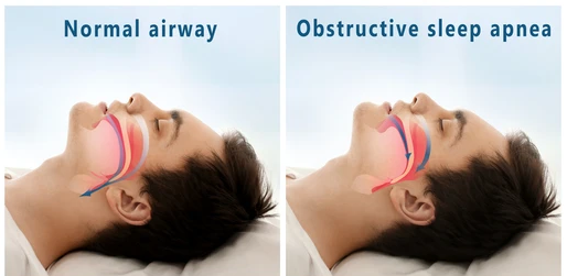 ” How to Overcome Sleep Apnea Guide for a Better Night’s Sleep “