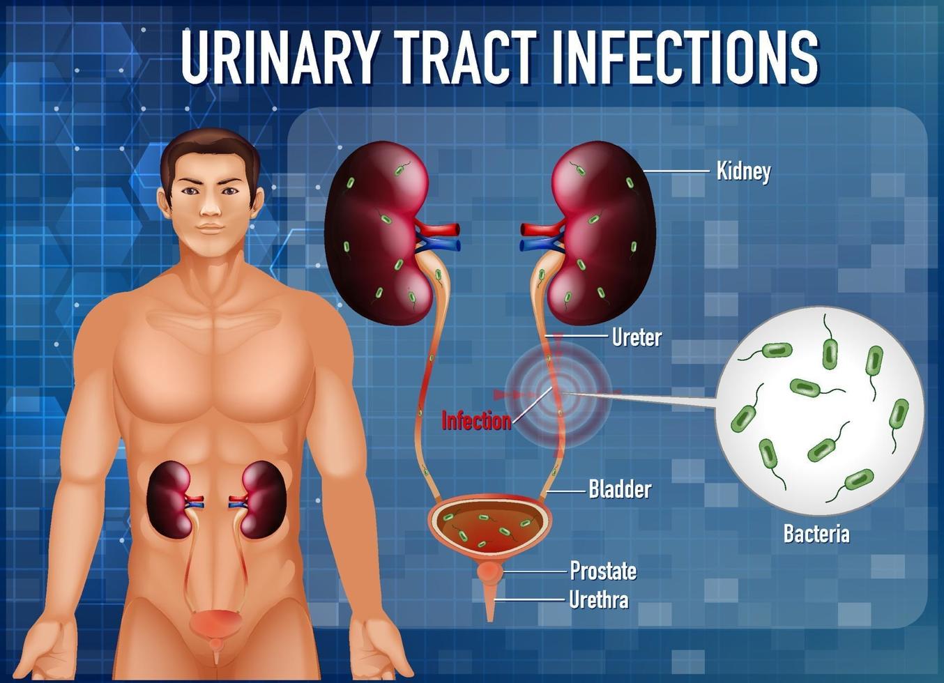 urinary tract infection